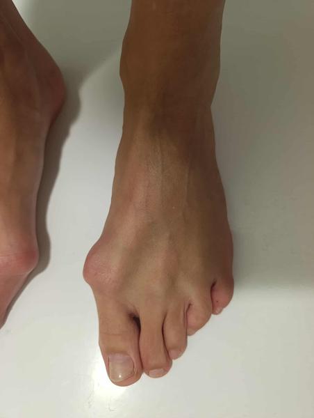 Hallux Valgus - vbočený palec - operace Mica