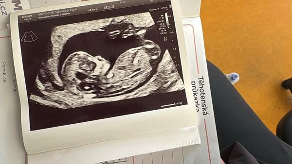Je to podle ultrazvuku opravdu chlapeček?