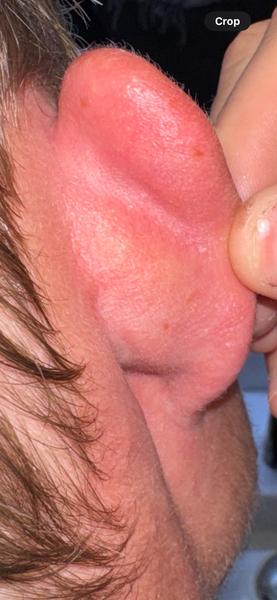 Vyrážka. Co to může být a jak to léčit?