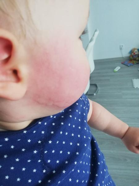 Alergie u dětí: Příznaky a řešení zkušeností rodičů