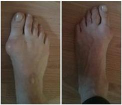 Hallux valgus - vybočený palec Hallux valgus - vybočený palec