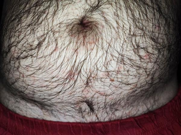 Pupínky a svědění celé rodiny. Je to svrab nebo ekzém?