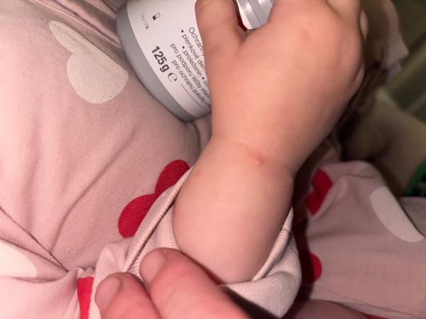 Jak na pupínky u 15měsíčního dítěte?