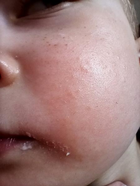 Vyrážka na obličeji a krupička po těle. Co si o tom myslíte?