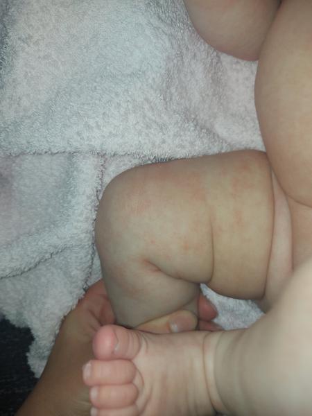 Vyrážka u dvouměsíčního dítěte: Co to může znamenat?