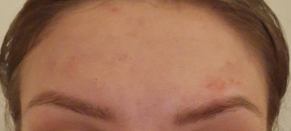 Jak zjistit, co se objevilo na čele?