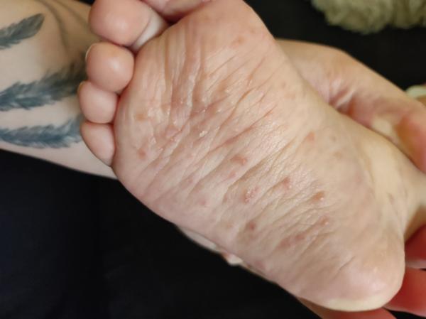 Pupínky od 4. měsíce. Co to může být?