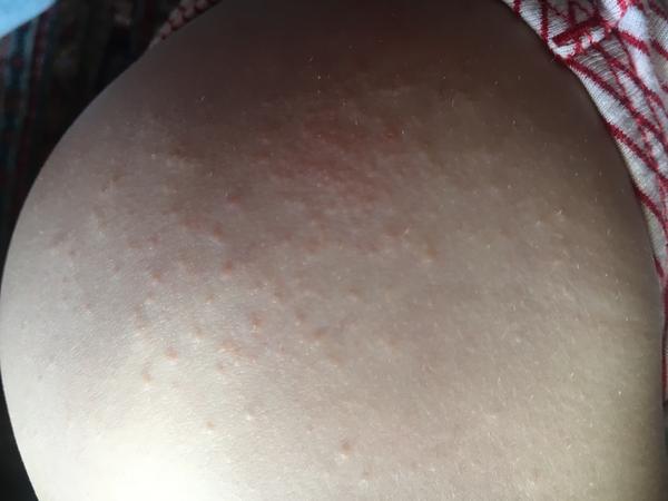 Ekzém u 3 letého dítěte. Hodně se škrábe a kortikoidy nepomáhají. Co více zkusit?