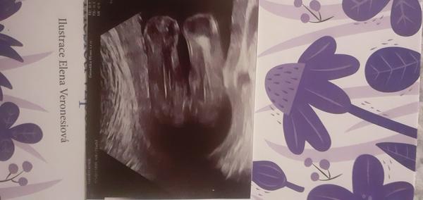 Pohlaví holčička nebo chlapeček🙂. Co myslíte vy?