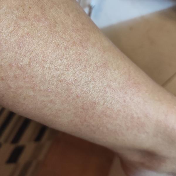 Může mít dospělý pátou nemoc? Zkušenosti a příznaky