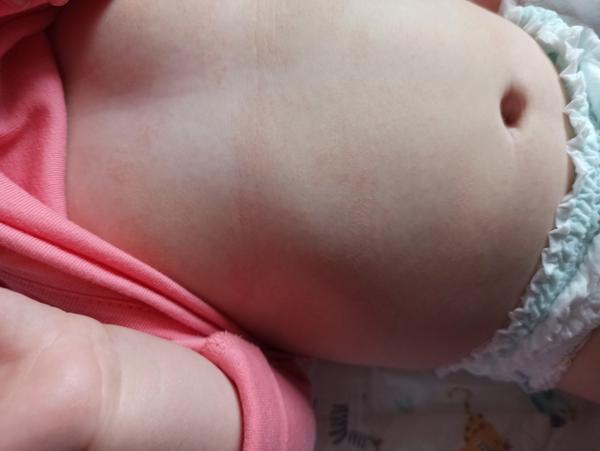 Krupička na bříšku u miminka. Jaké jsou příčiny a řešení?