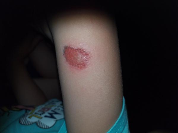 Navštívit lékaře - kožní defekt na ruce