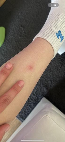 Bulka po klíštěti. Co dělat?