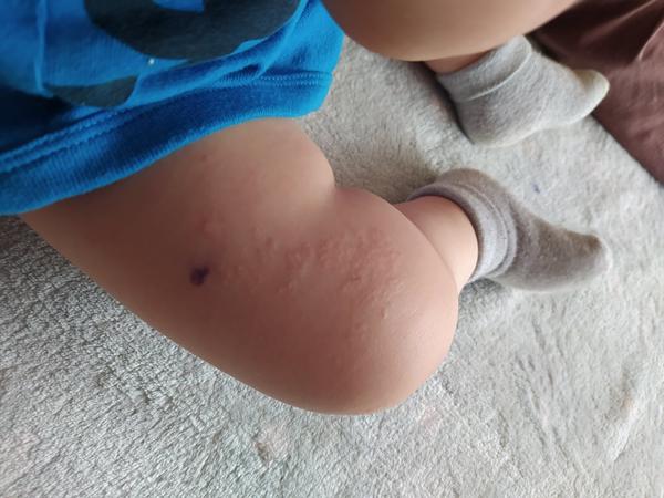 Pupínky slévající se v jeden velký flek. Mohlo by se jednat o ekzém?