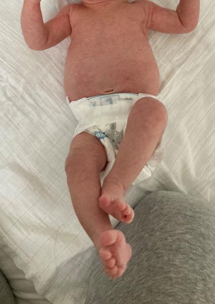 Mramorová kůže u novorozence. Čím by to mohlo být? Obávat se něčeho?