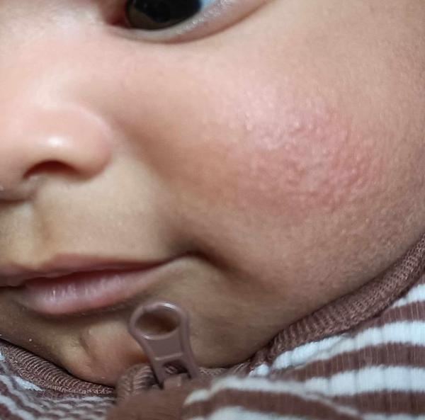 Zinková mast a vyrážka u miminka. Pomáhá opravdu?