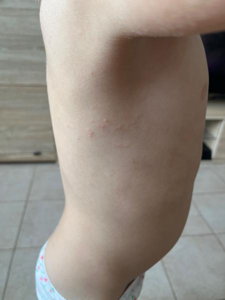 Malé pupínky po celém těle u dítěte. Co dělat?