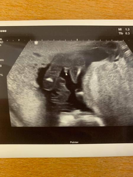 Holka nebo kluk podle ultrazvuku v17.tt?