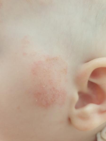 O jakou vyrážku se může jednat?