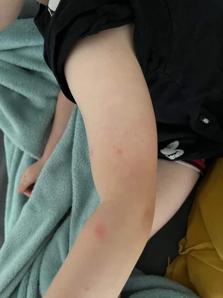 Je vyrážka způsobena krémem nebo potravinami? Diskuze pro maminky