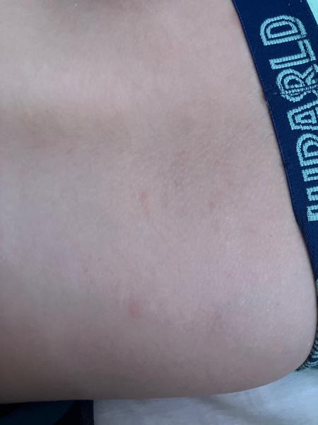 Červené flíčky. Mohou být z Nurofenu?