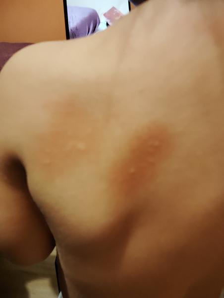 Vyrážka u dvouleté dcery. Co by mohlo způsobit?