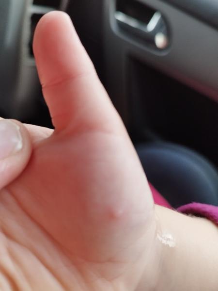 Puchýřky na rukou. Co by to mohlo být?