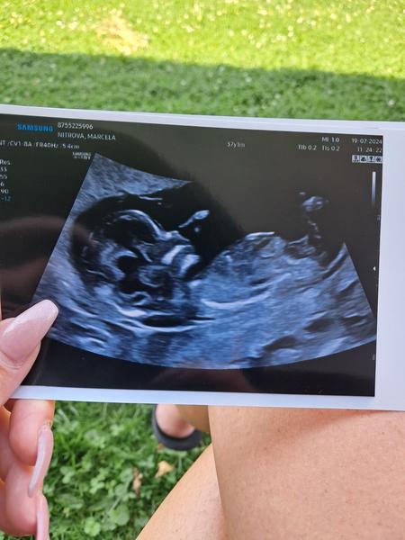 Jak tipujete pohlaví podle ultrazvuku ve 14. týdnu?