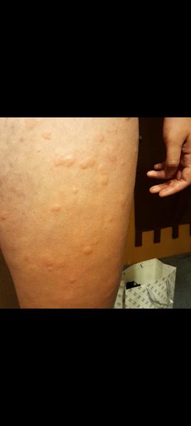 Svědivé pupínky po těle: Jaké jsou možné příčiny?