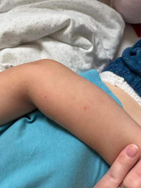 Je vyrážka způsobena krémem nebo potravinami? Diskuze pro maminky