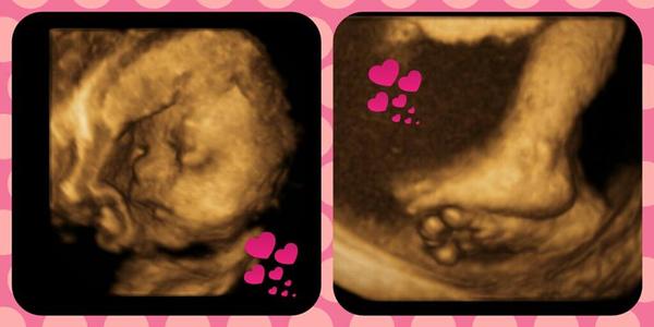 4D ultrazvuk, doporučuju