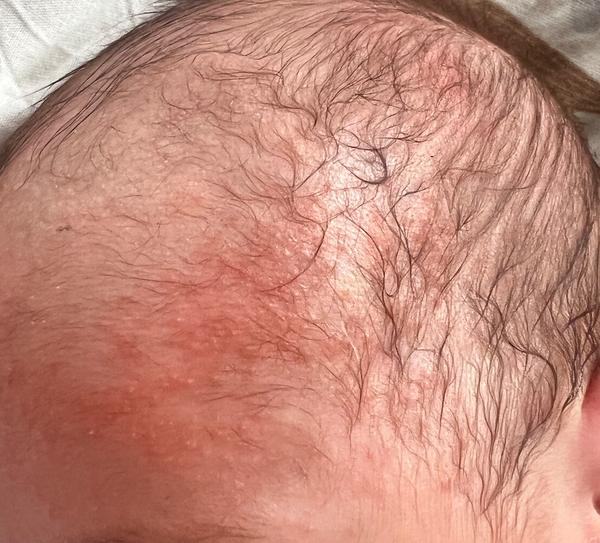 Co způsobilo vyrážku u měsíčního kojence?