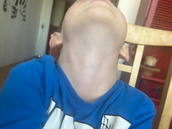 Červené fleky u syna. Jsou to neštovice?