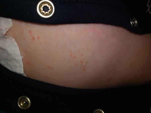 Vyrážka na bříšku u 7denního syna. Co by to mohlo být?