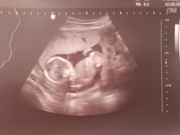 Ultrazvuk: Holka nebo kluk? Co si myslíte?