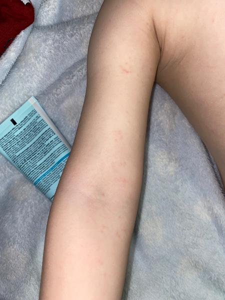 Vyrážka u tříletého dítěte. Jak to řešit?