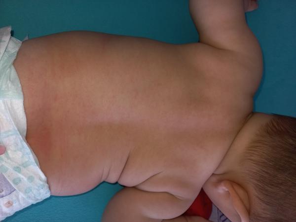 Červené malinké skvrny na zádech a bříšku. Jsou to potničky?