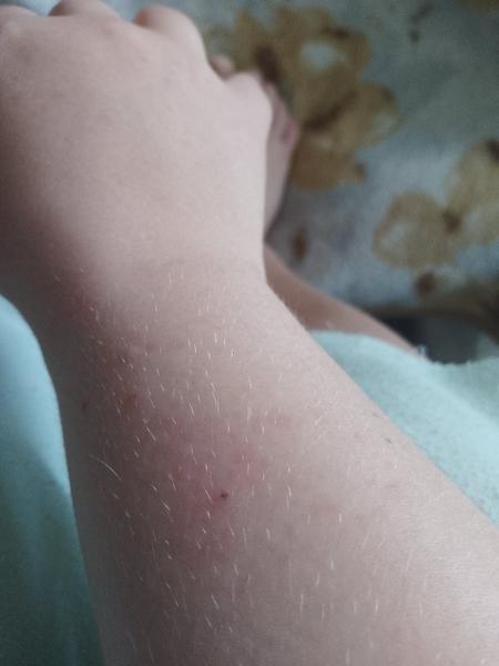 Vyrážka na ruce. Co by to mohlo být?