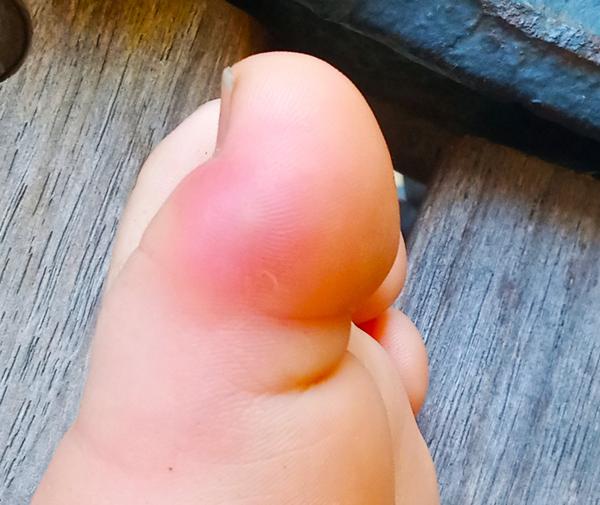 Červená boule na palci u nohy