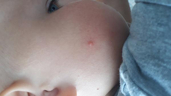 Problémy u 2letého synka. Ekzém či alergie?