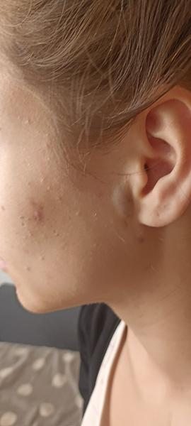 Prasklá žilka na obličeji: Setkal se s tím někdo?