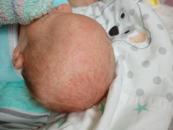 Pupínky. Jedná se o potničky nebo novorozenecké akné? Co koupit, abych dcerce pomohla?