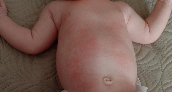 Alergická reakce na HiPP Combiotic: Jak ji poznat?