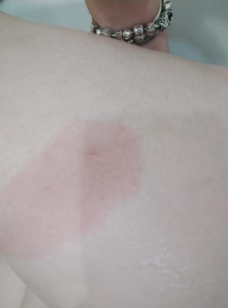 Flek po klíštěti při borelióze. Může svědit?