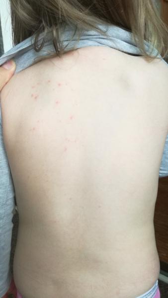 Kopřivka nebo neštovice. Co myslíte?