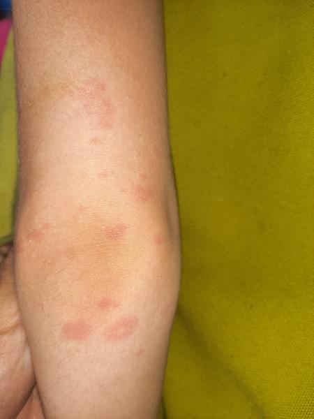 Vyrážka na loktu a kolenou: Alergická reakce po antibiotikách?