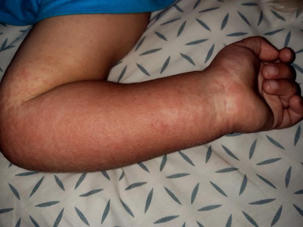 Sluneční vyrážka. Co pomohlo u dětí?