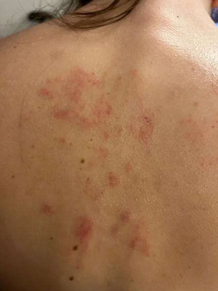 Vyrážka. O co by se mohlo jednat?