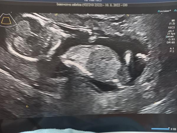 Vidíte pohlavní hrbolek na 1. screeningu?