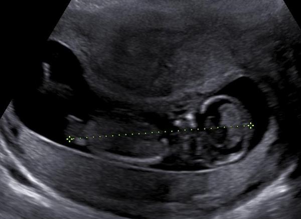 Myom v těhotenství a pohlaví miminka. Je běžné, aby myom, který do té doby nebyl nikdy popsán, způsobil tak významný akustický stín?